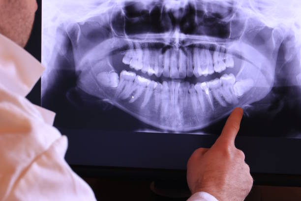 Best Knocked-Out Tooth (Avulsed Tooth) Treatment in Madison, WV